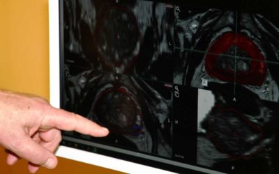 Urologové pomocí nové zobrazovací jednotky odhalí i ty nejmenší nádory prostaty