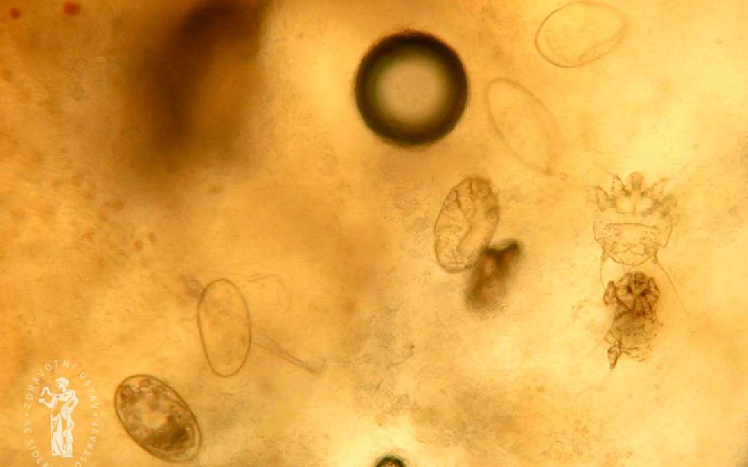 Svrab v Česku na vzestupu, v Moravskoslezském kraji se objevilo 86 případů